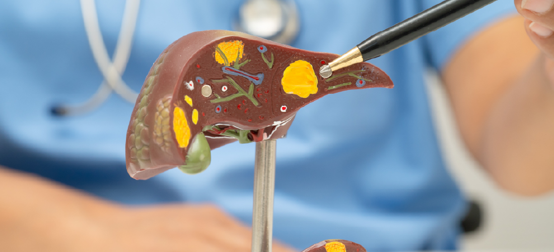 Ablation for liver tumours treatment at Rivea Vascular Center Hyderabad