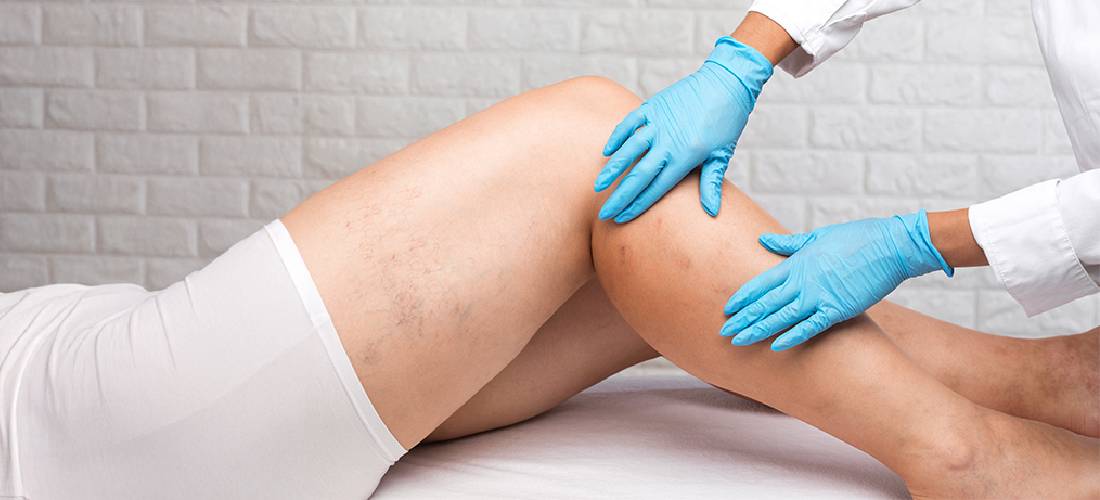 Chronic Venous Insufficiency Treatment – RIVEA Vascular