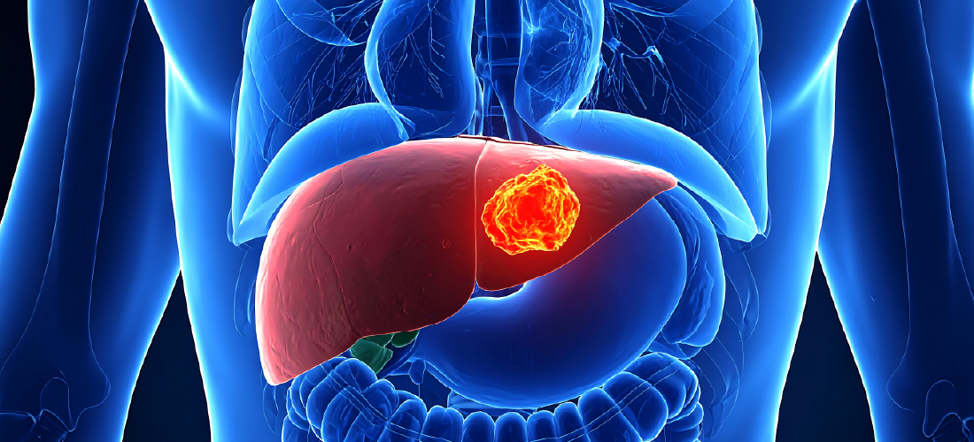 Minimally invasive interventional radiology treatment for liver tumours
