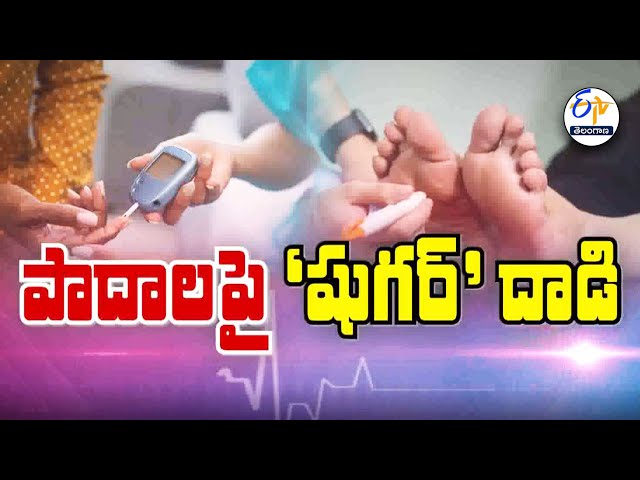 Diabetic foot care awareness – RIVEA Vascular's specialized treatment for diabetic patients