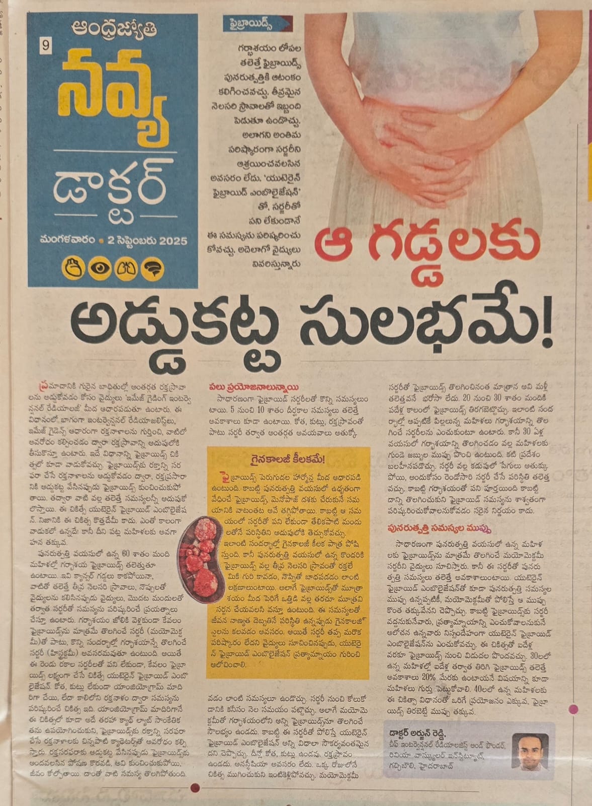 Fibroid relief – minimally invasive treatment by RIVEA Vascular