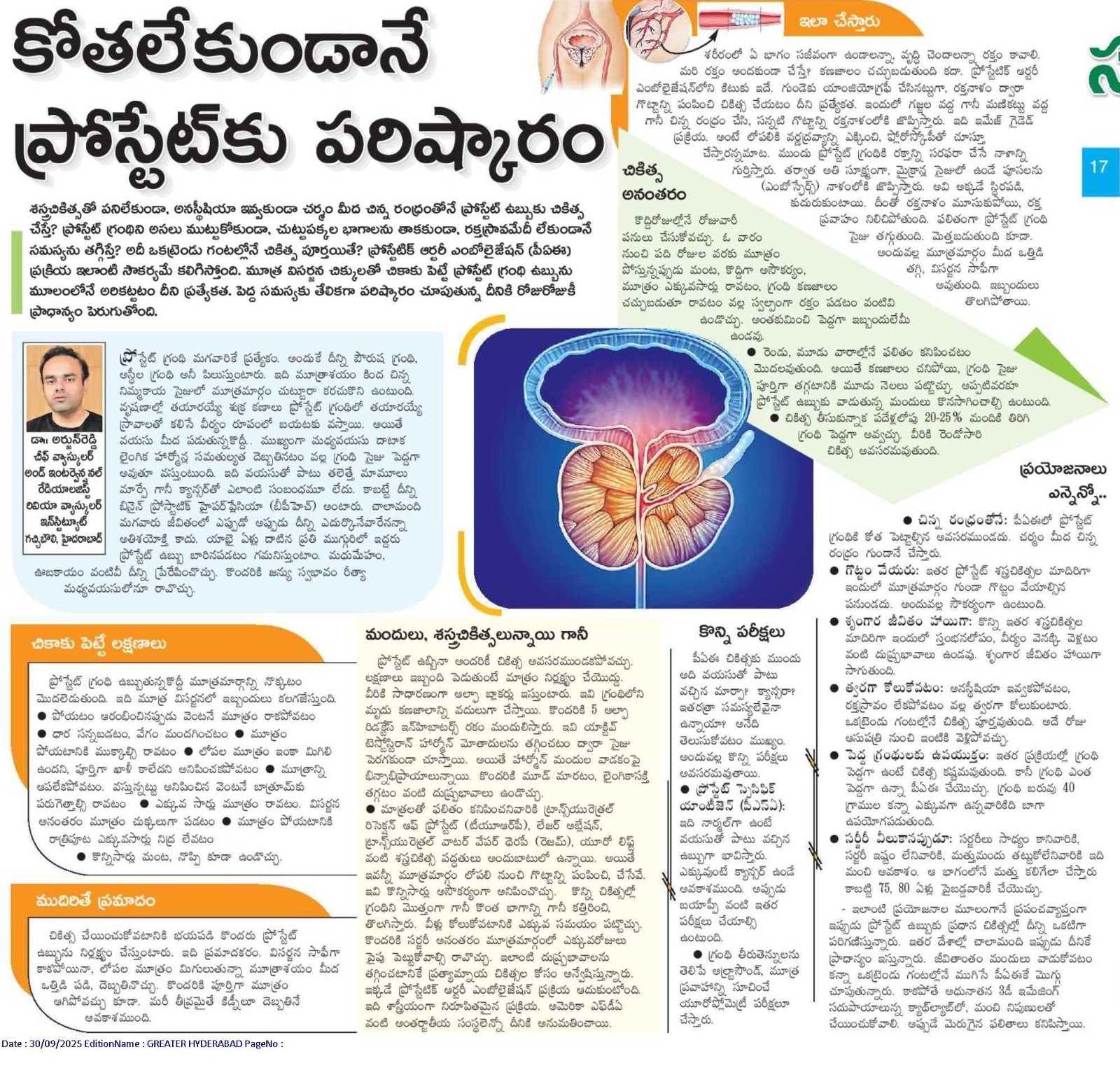 Rivea minimally invasive prostate embolization procedure