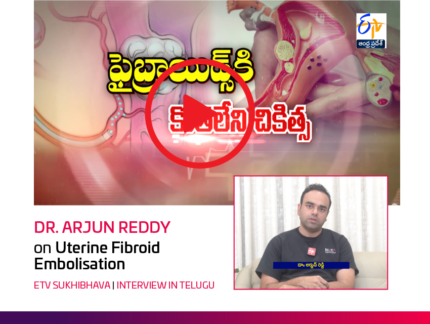 Fibroids treatment without surgery at RIVEA Vascular Institute Hyderabad